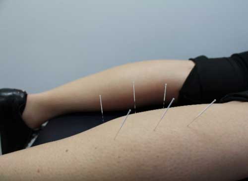 Dry Needling